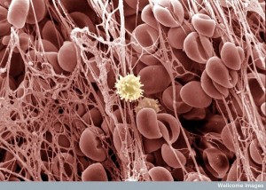 blood clot