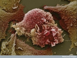 lung cancer cells